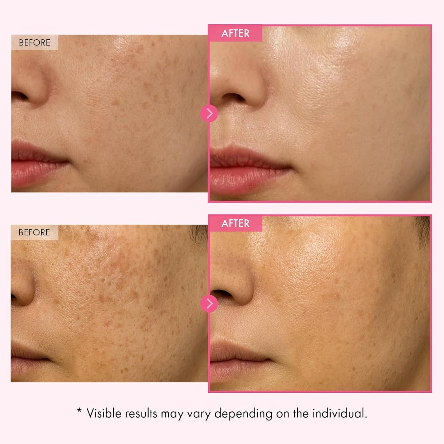 Alpha Arbutin + TXA Cream