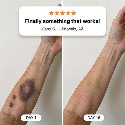 💥75K+ SOLD💕- Yoopulse® Bruise Repair & Skin-Strengthening Cream